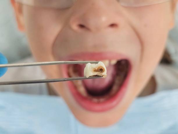 Best Emergency Dental Care for Abscessed Tooth in Charlottesville, VA